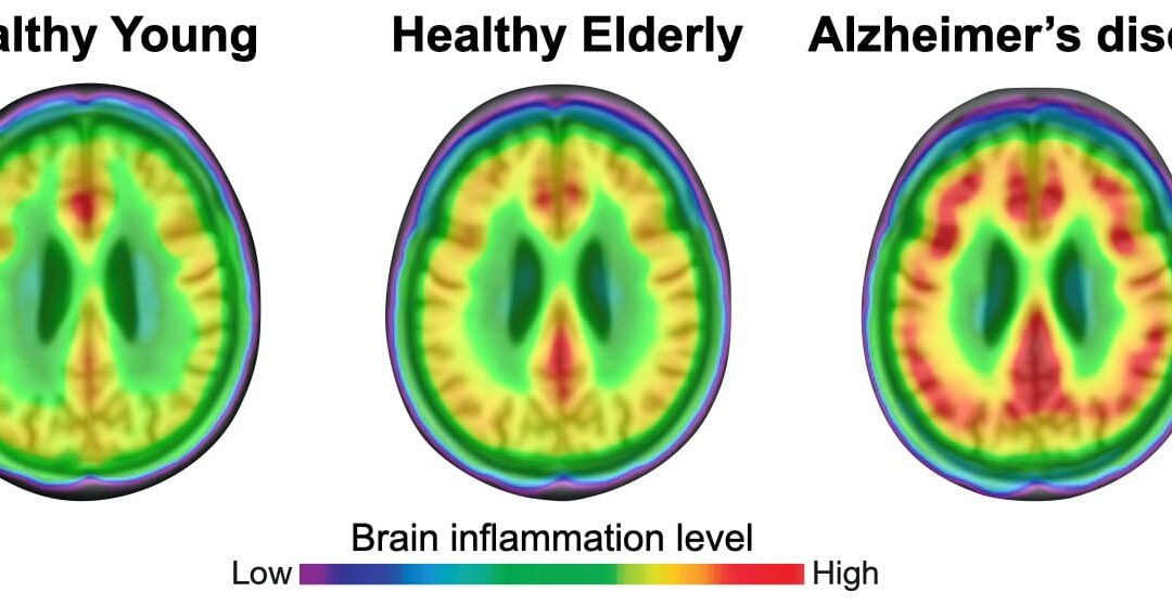 Brain Tissue Inflammation Drives Alzheimer’s Disease